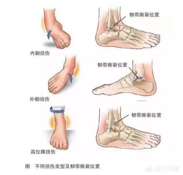 脚扭伤怎么处理:脚崴后第一时间怎么处理比较好？