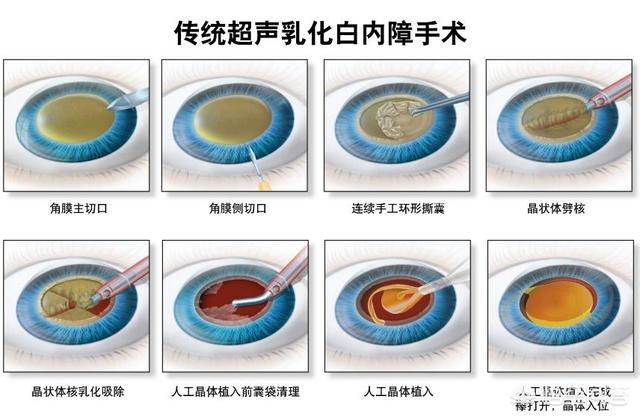 做完眼袋眼球结膜充血:做完眼袋眼球结膜充血 我做了人工晶体一个多月，眼睛还红着，什么原因？