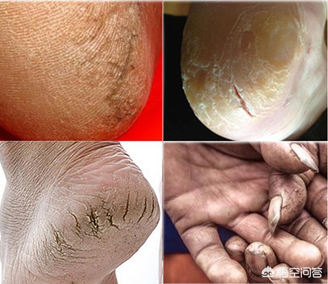 头条问答 - 手足皲裂是怎么回事?(5个回答)