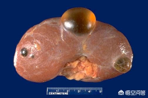 是真正的单纯肾囊肿,所谓单纯肾囊肿,可以理解为肾实质里面的小水泡