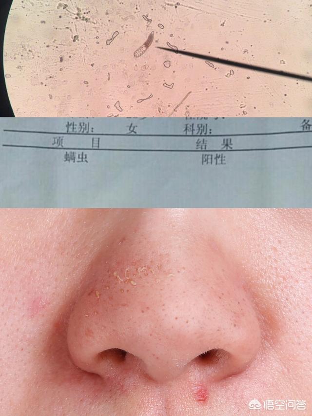 头条问答 - 痘痘,痤疮,黑头,粗大的毛孔内可能住着螨虫,应该如何治疗?