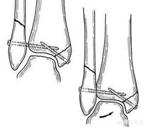胫腓骨骨折对位对线不佳:胫腓骨双骨折内固定手术三个月了居然还没长好，什么问题？