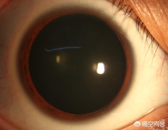 阿托品散瞳时间:儿童第一次配近视眼镜必须散瞳吗？散瞳过程麻烦吗？
