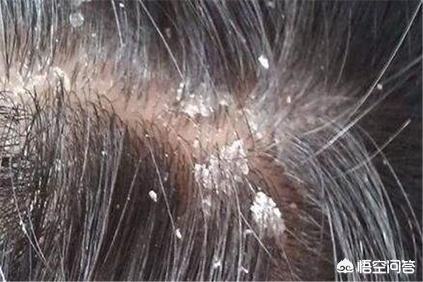 如何知道自己头皮有没有螨虫，头上出现什么症状，才能知道头皮被螨虫“霸占地盘”，该如何除螨
