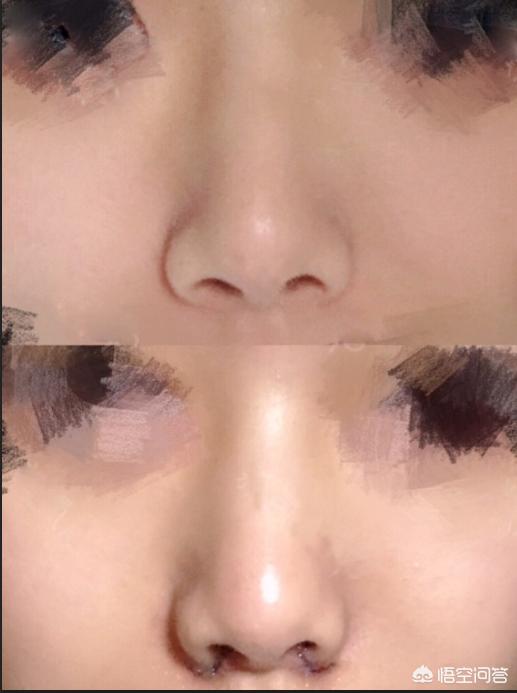 头条问答 - 鼻子大,怎么整容比较好?(8个回答)