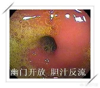 反流性胃炎怎么治疗(反流性胃炎的治疗方法)