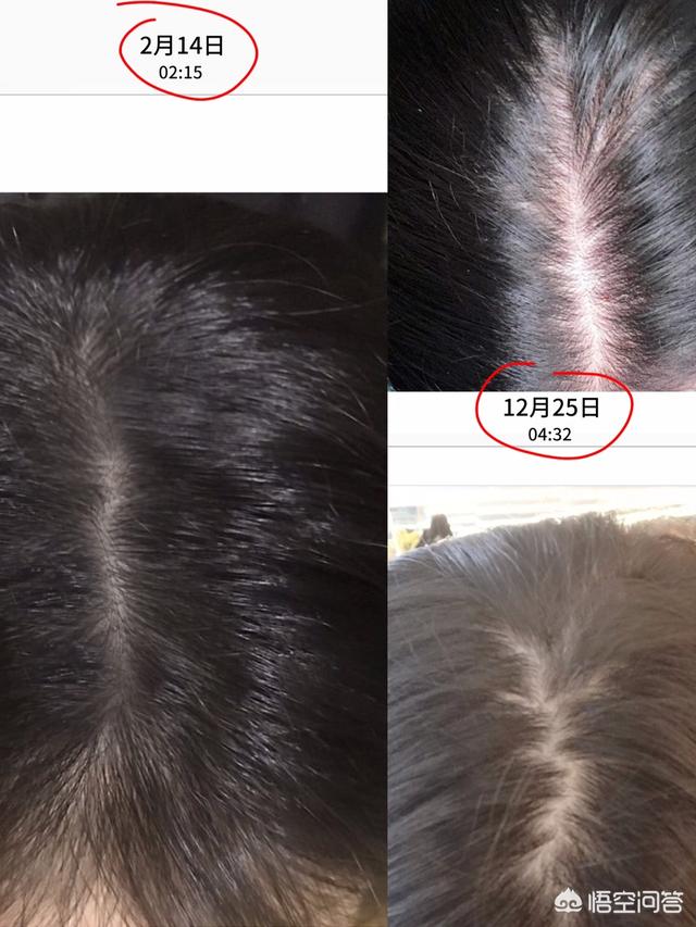 脱毛症:十个脱发八个螨，头螨是脱发的原因吗？
