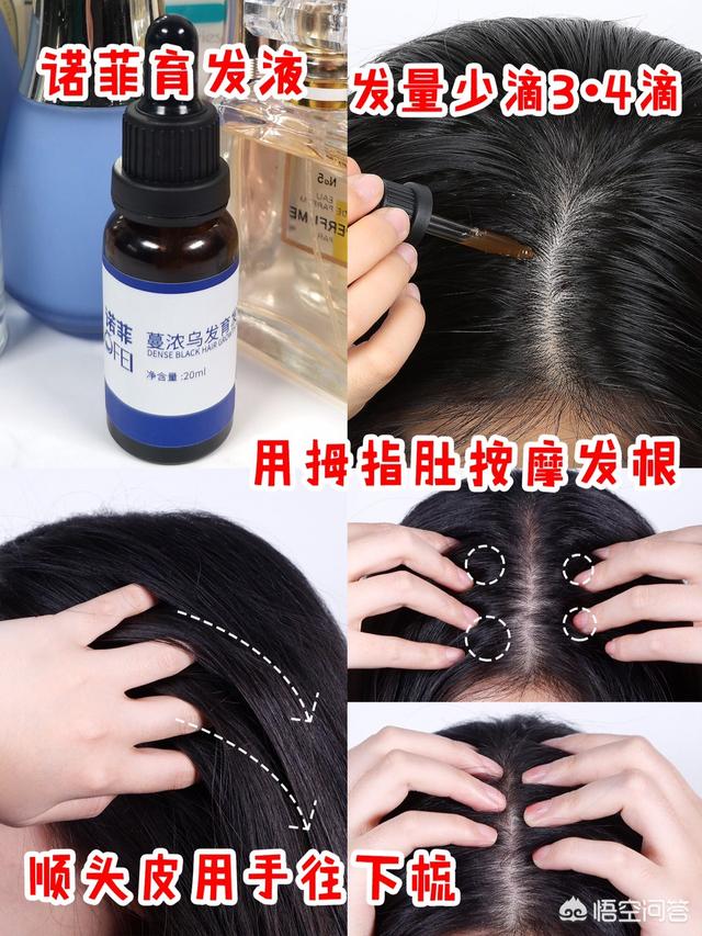 脱毛症:十个脱发八个螨，头螨是脱发的原因吗？