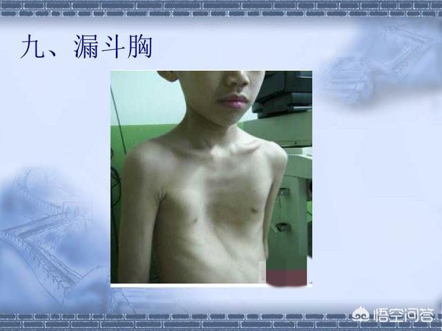 佝偻病症状:佝偻病症状表现 小孩子缺钙主要有哪些表现？