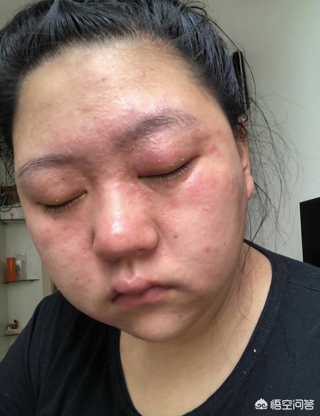 前哨战:你知道皮肤屏障功能有多珍贵吗？