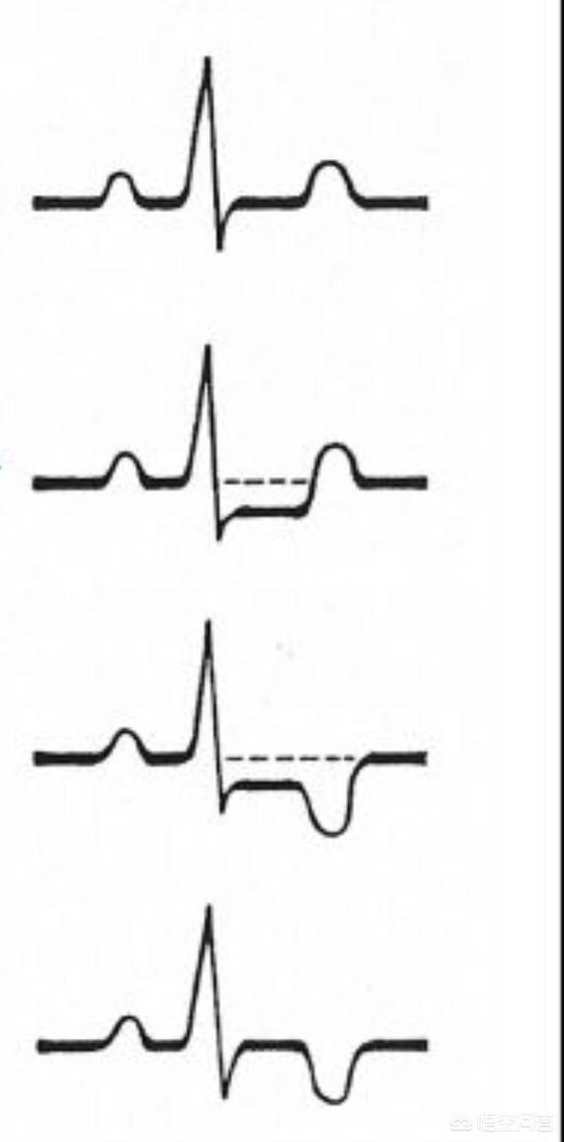 心电图t波异常图片