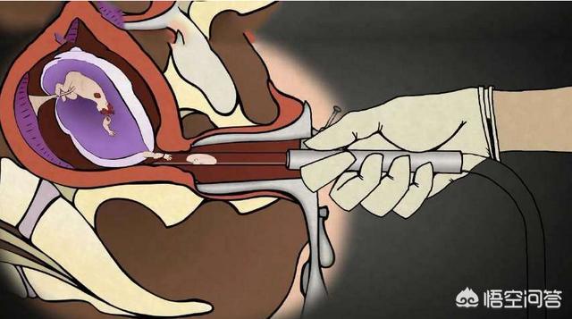 怀孕八个月可以做引产手术吗，怀孕8个月打掉孩子会有哪些危险吗
