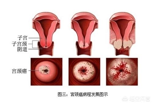头条问答 - 听说使用劣质卫生巾容易患子宫癌?是这样吗?(1个回答)