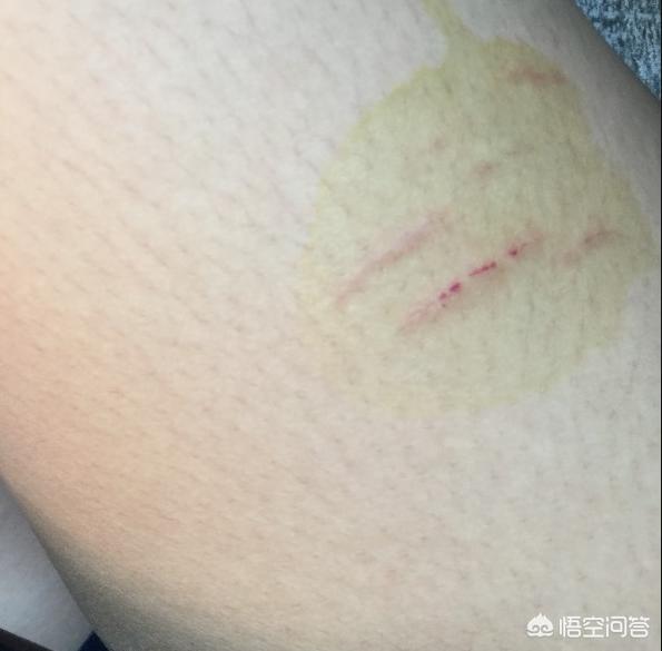 被猫咬了要打狂犬疫苗吗,被猫抓了，需要打狂犬疫苗吗？