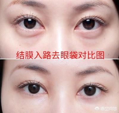 田永成隆鼻:皮肤长斑与肌肤缺水有关吗