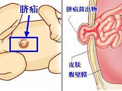 曲宝善脐疝带:两个月的宝宝脐疝包很大，有没有什么方法缓解？