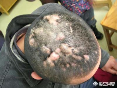 头条问答 - 头上长的脓包和"疙瘩"是什么,能挤掉吗?(2个回答)