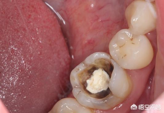 其实不会很贵,300多一颗,具体得看哪个城市,还有龋坏程度,龋洞较小的