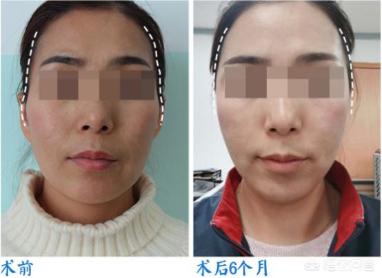 自体脂肪填充太阳穴能让额头变宽吗？