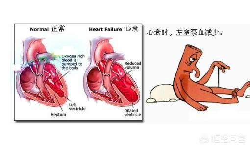 先天性心脏病的症状:先天性心脏病的症状主要是 心脏病能否引起呼吸道感染、流鼻涕、流泪、鼻塞和咳嗽等症状呢？