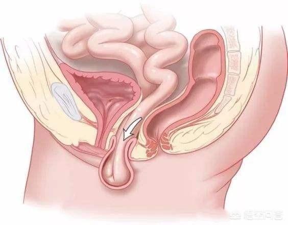 子宫脱垂的常见原因有哪些，轻度子宫脱垂怎么减肚子？