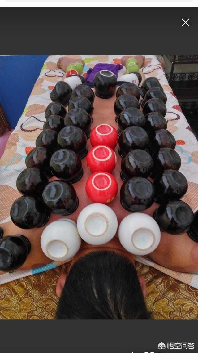 刮痧拔罐能去除体内湿气吗拔火罐真的能祛除身体湿气吗你会去拔火罐吗