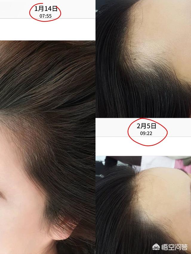 脱毛症:十个脱发八个螨，头螨是脱发的原因吗？