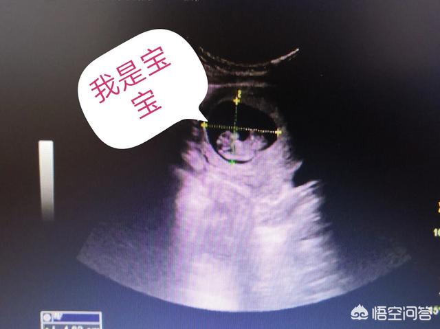 有过胎停育经历的姐妹们，你们后来顺利怀孕，生下来了吗？插图32