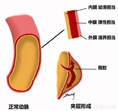 肠梗塞会腹泻:腹主动脉夹层会引起腹泻吗？ 肠梗阻会腹泻吗