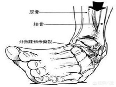 如何预防习惯性崴脚，打球老崴脚，怎么预防受伤
