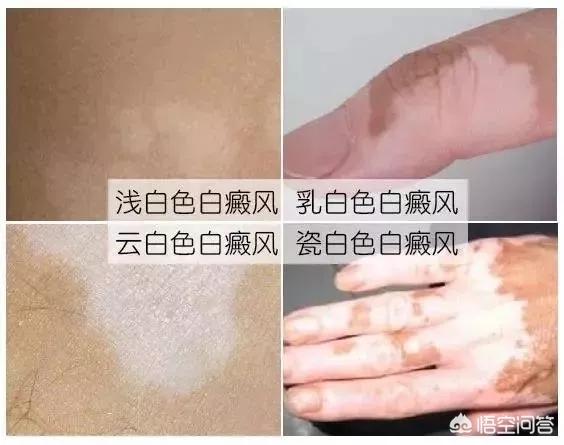 伍德氏灯检查淡白色:汗斑与白癜风在伍德灯下好区分吗？