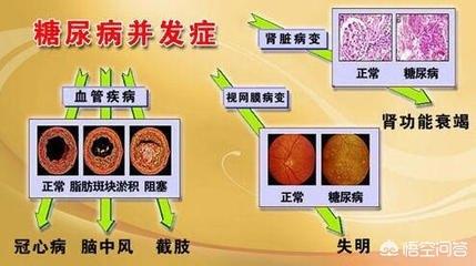 无痛性跛行:无痛性跛行是什么引起的 高血压、脑梗死、心衰，是糖尿病并发症吗？