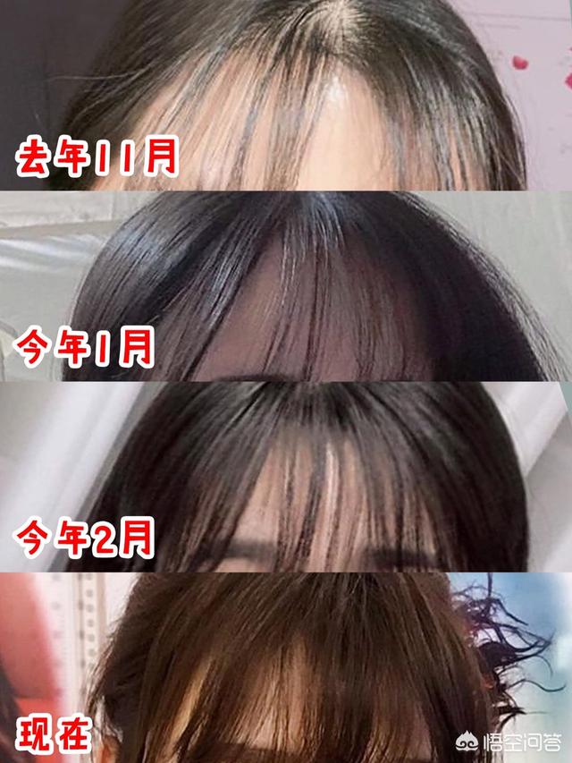 脱毛症:十个脱发八个螨，头螨是脱发的原因吗？
