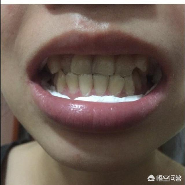 有什么牌子的牙膏是真的每天刷牙就能让牙齿变白的？