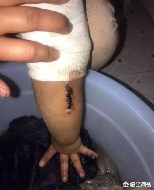 头条问答 - 泉州11岁女孩疑似遭后妈毒打,伤痕累累, 你怎么看?