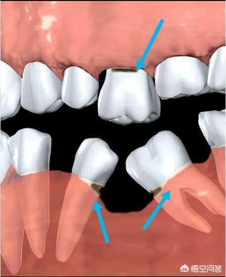 牙齿黑三角,牙齿为什么会出现“黑三角”？