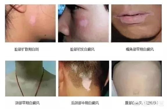 伍德氏灯检查淡白色:汗斑与白癜风在伍德灯下好区分吗？