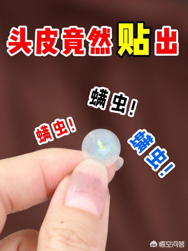 脱毛症:十个脱发八个螨，头螨是脱发的原因吗？