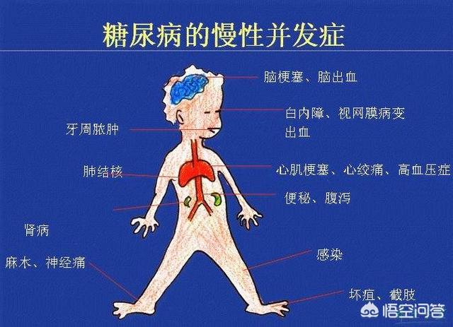 晚期糖尿病有什么症状:糖尿病加重时，会有什么症状？