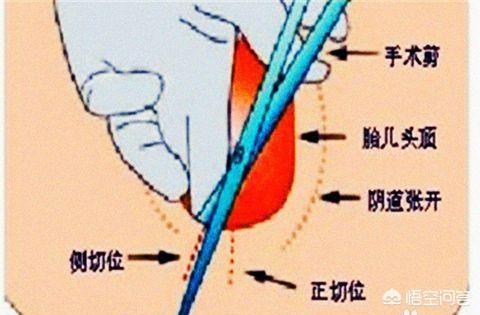 顺产最怕遇到的侧切,很多准妈妈直接选择剖腹产,其实是可以避免的,怎样才能避免呢？