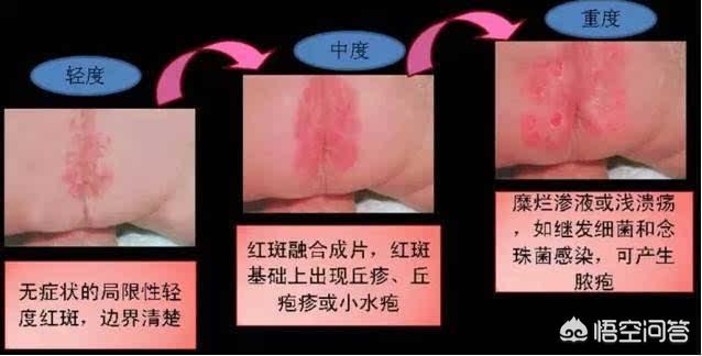 宝宝24小时都穿尿不湿好吗，宝宝一直用纸尿裤有什么坏处？