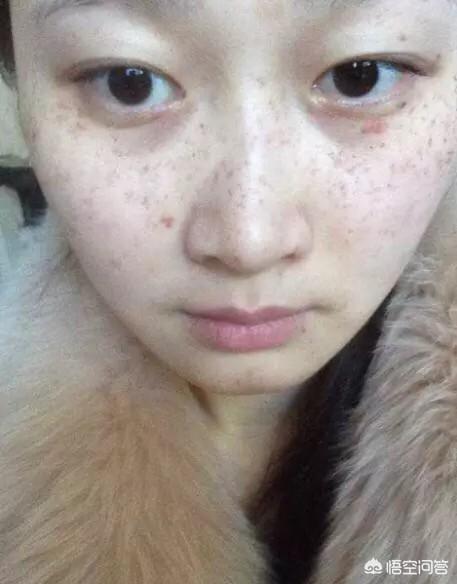 排毒祛斑(王者家族排毒祛斑)