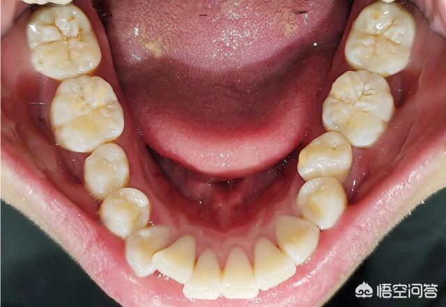 头条问答 - 牙医是如何观察牙齿的vs普通人是如何观察牙齿的?