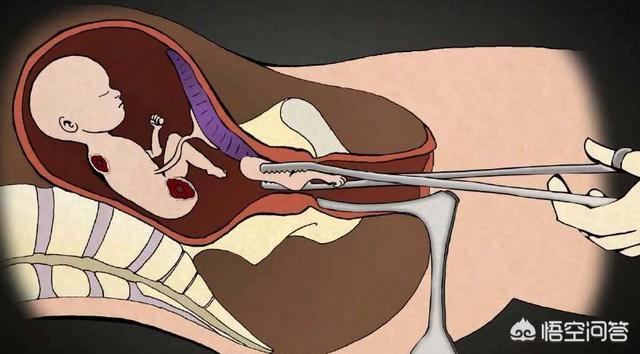 怀孕八个月可以做引产手术吗，孕8个多月不想生了怎么办？
