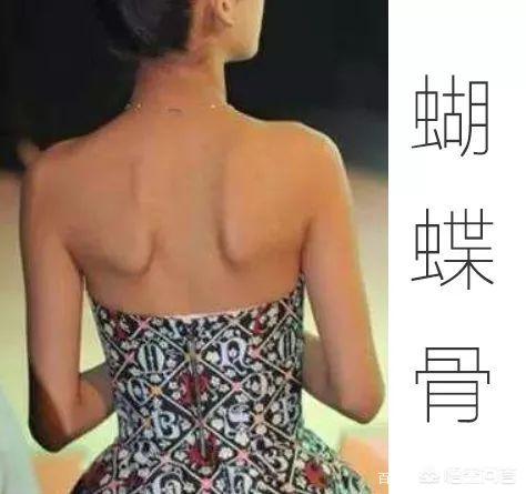 蝴蝶骨竟然是翼状肩胛骨,该如何纠正?-终于实宪