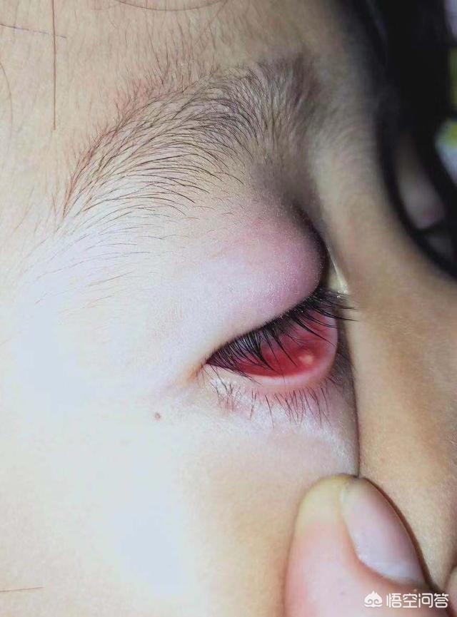 睑腺炎初期图片眼睑图片