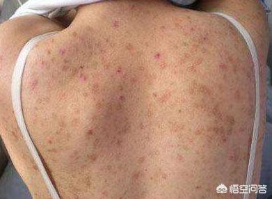 后背长痘巨难看惨遭男朋友嫌弃怎么办