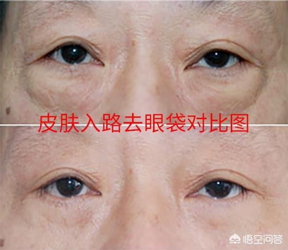 田永成隆鼻:皮肤长斑与肌肤缺水有关吗