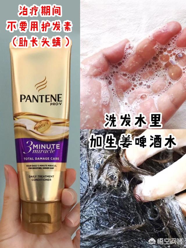 脱毛症:十个脱发八个螨，头螨是脱发的原因吗？
