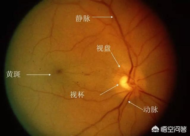 16岁眼睛近视500度图片